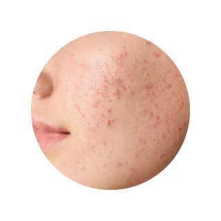 Plushderm targets acne causing bacteria hq